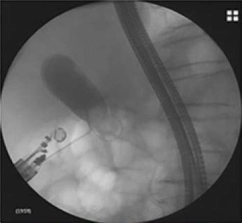 Endoscopic ultrasound-guided choledochoduodenostomy. Under real-time ...