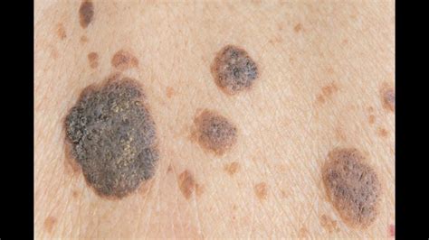 Duct Tape To Remove Seborrheic Keratosis at Karima Parker blog