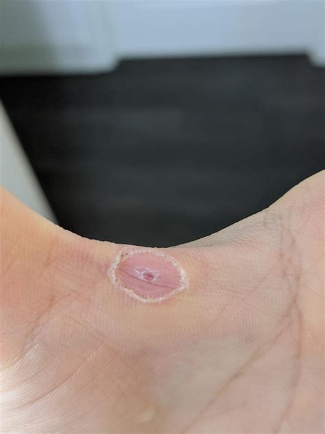 Did a liquid nitrogen treatment 2 weeks ago. Got a blood blister which