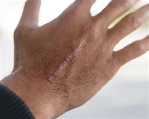 Scar Types and Causes | NewGel+