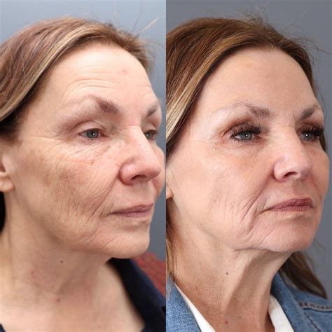 laser marion plastic surgery