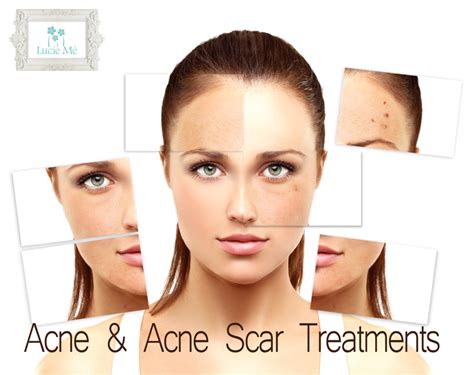 Acne & Acne Scar Treatments – Lucie Me Medical Spa