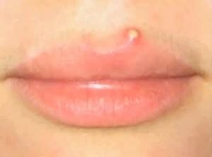 Pimple on Lip Line – Inside the Clinic