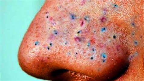 Unbelievable Blackhead Removal 2024: What’s the Best Method for You? - pvghy3o