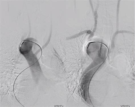 Aortic Arch | neuroangio.org