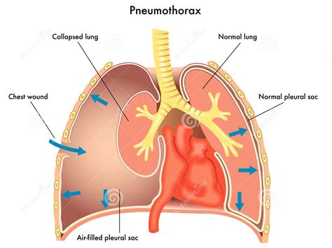 Open Pneumothorax