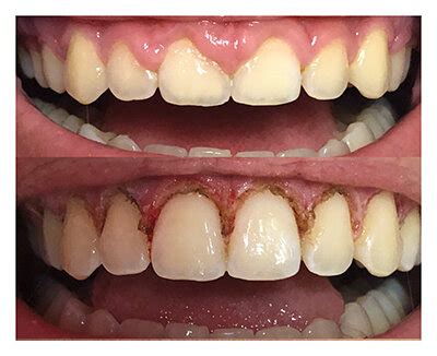 Hollywood Orthodontics featuring Smile Transformation, Invisalign and ...