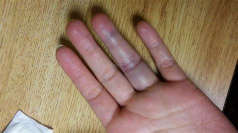 Jammed Finger Nail Black And Blue at Bruce Moreno blog
