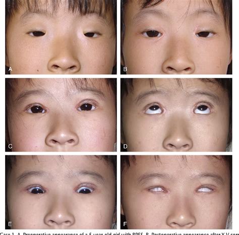 Blepharophimosis Ptosis Epicanthus Inversus Syndrome Or Bpes