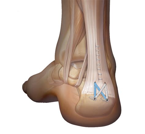Insertional Achilles Tendonitis