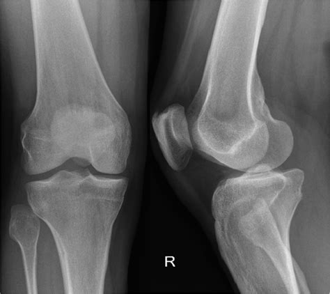 Dislocation of the proximal tibiofibular joint, do not miss it | BMJ