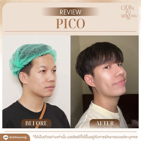 Unbelievable Blackhead Removal 2024: My Honest Review & Before/After Pics. Image 11