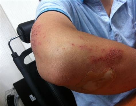 reduce bruises family health kidspot nz