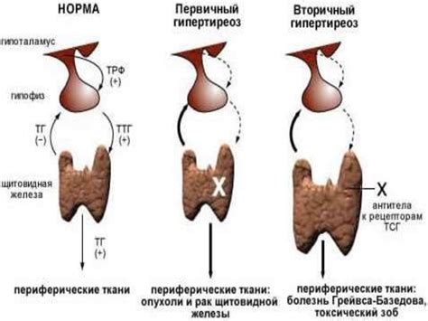 Гипертиреоидизм - презентация онлайн