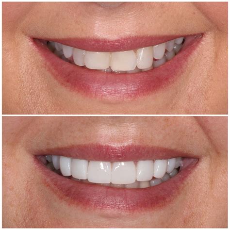 Teeth Veneers Before And After Photos at Inez Bennett blog