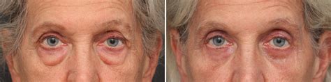 Lower Eyelid Surgery Photos | Philadelphia, PA | Patient 3707