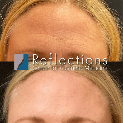 botox forehead wrinkles    expert guide