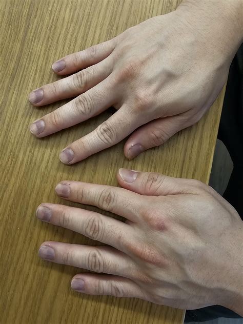 What is the cause of my fingernails turning black? It has been like