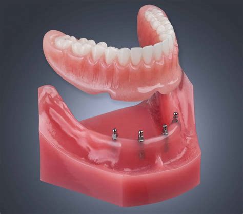 Shatkin Mini Dental Implants | Dr. Todd E. Shatkin | Aesthetic Associates