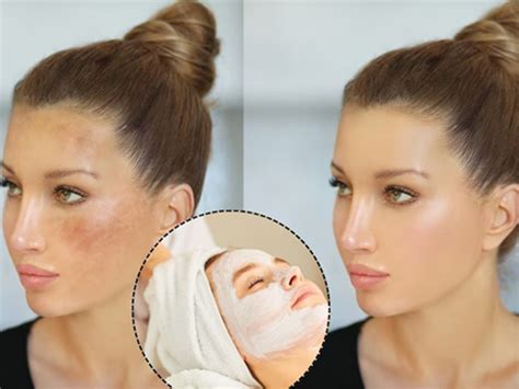 skin care     remove blemishes   face  curd