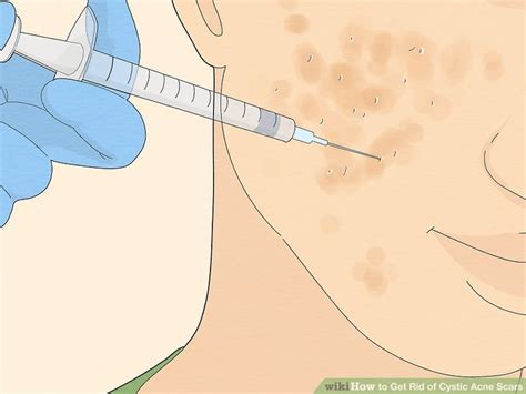 4 Ways to Get Rid of Cystic Acne Scars - wikiHow