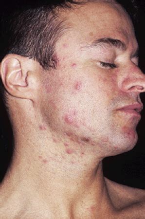 bacterial skin infections flashcards quizlet