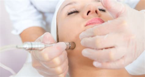 Is Microdermabrasion an Effective Treatment for Acne Scars