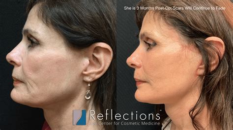 Lower Facelift Performed Under Local Anesthesia Before & After Photos ...