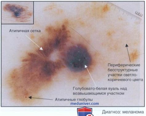 Диагностическая дерматоскопия - алгоритм, этапы