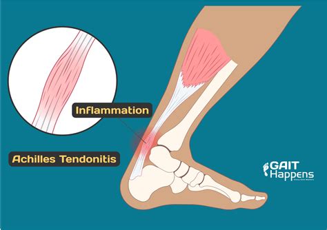 symptoms  achilles tendonitis tendinopathy gait