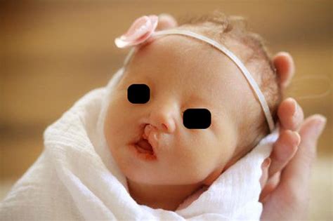 Edwards Syndrome Chart