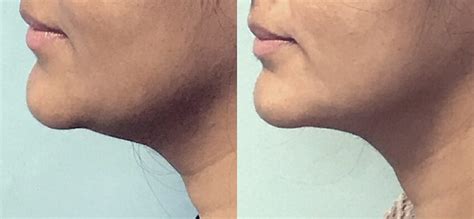 Double Chin Liposuction – An Essential Guide - Chin Liposcution