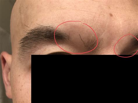 Alopecia beginning to attack eyebrows - options? : r/alopecia_areata