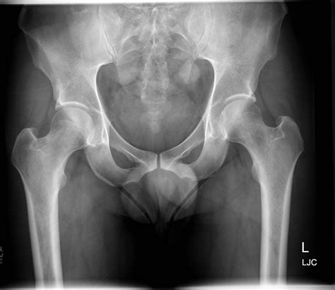 normal hip buyxraysonline