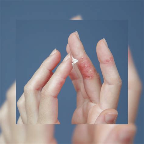 breaking  steroid cream myth kuan yin apothecary