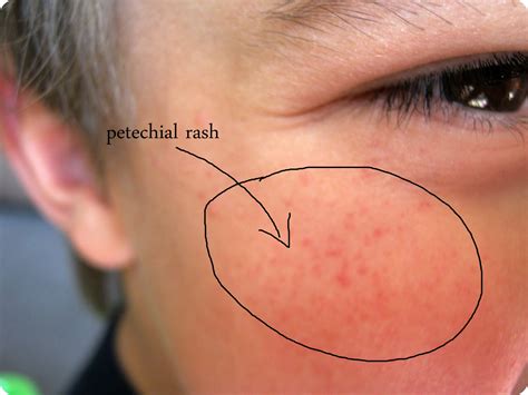 Meningitis Rash