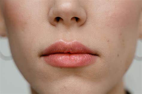 Small Bumps on Lips: Fordyce Spots and How to Treat Them - Maximum ...