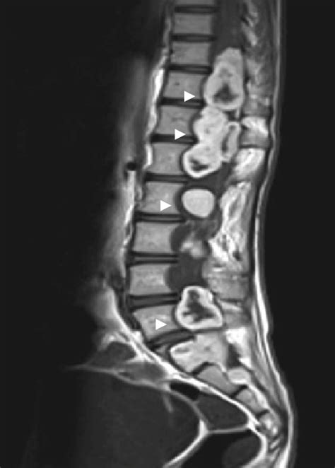 multiple spinal schwannomas   cystic change  nf