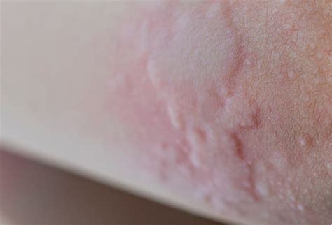 hives urticaria pictures types  treatment