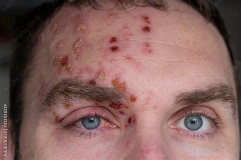 man  herpes zoster shingles   face close  inflamed