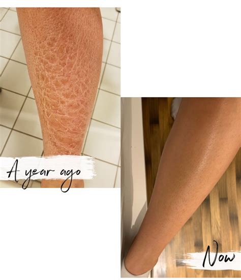 Ichthyosis Vulgaris