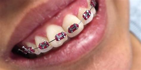 Top 10 colored of red braces for handsome teenage boys | Braces Explained