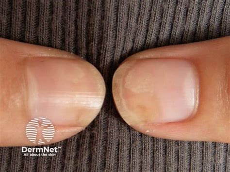 drug induced onycholysis image