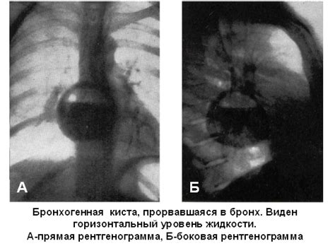 Киста легкого и средостения: симптомы осложнения и методы диагностики