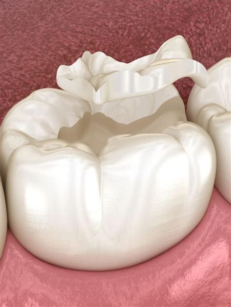 how to know if a tooth filling came out