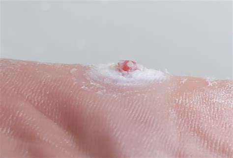 Verruca? Warts? Corns? I’ve used nearly all over the counter items for