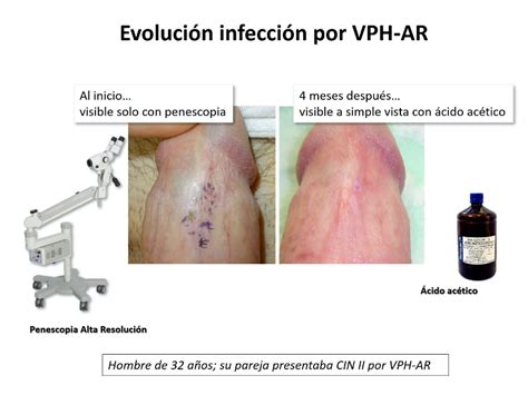 El VPH (Virus del Papiloma Humano): la ITS más común en hombres - Blog