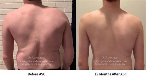 Scoliosis Surgery Before And After