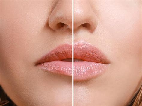 Fillers - Cherry Medical Aesthetics | Denver, CO