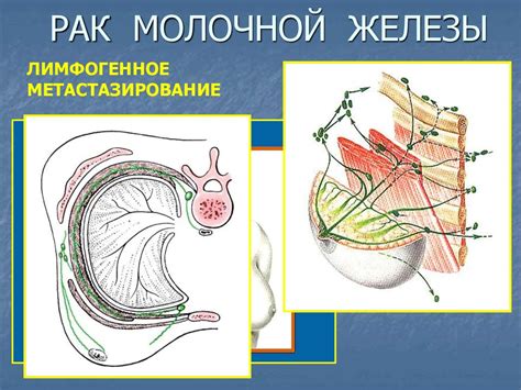 Рак молочной железы - презентация онлайн